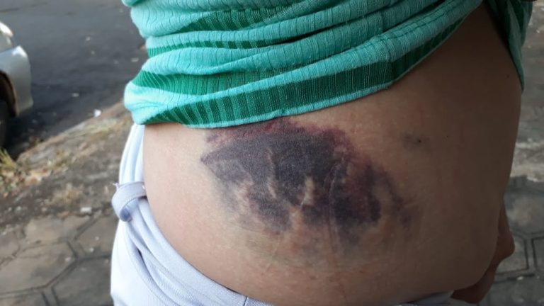 Vítima de assalto no Ipiranga tem clavícula fraturada por criminoso