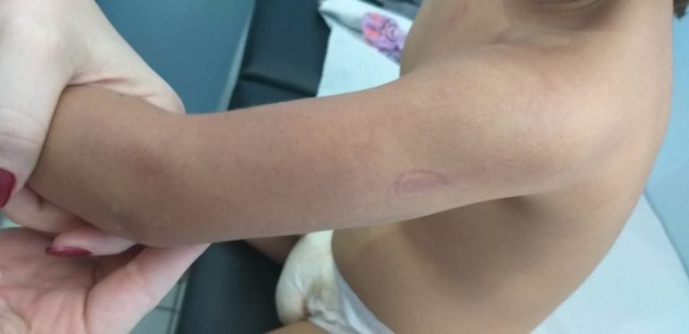 Criança de dois anos é vítima de maus-tratos em Serra Azul