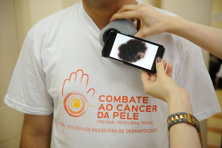 Pesquisadores da Unicamp desenvolvem software para diagnosticar melanoma