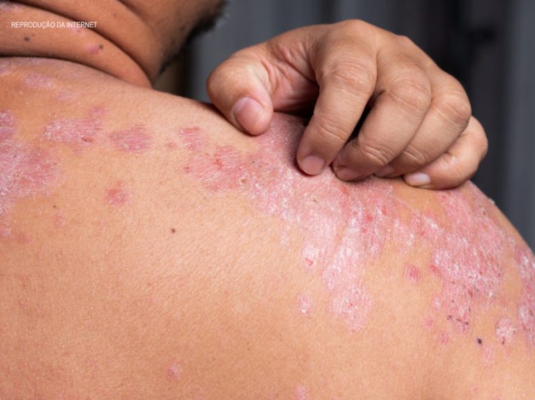 Maus hábitos podem provocar o desenvolvimento de psoríase