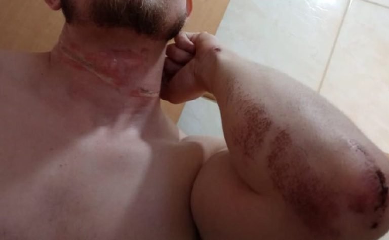 Vídeo | Homem que teve pescoço cortado por cabo da CPFL entra na Justiça por indenização