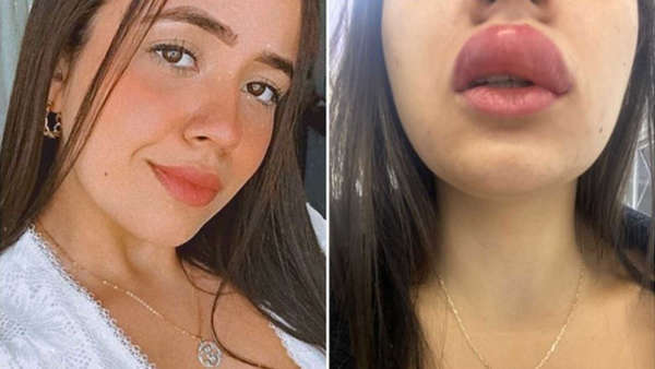 Garota fica com lábio gigante após ser picada por lacraia