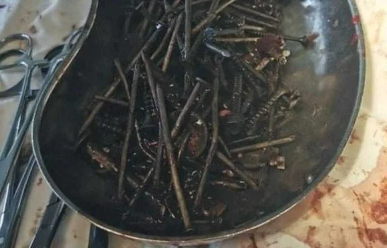 Médicos retiram 1 quilo de pregos e parafusos de estômago de paciente