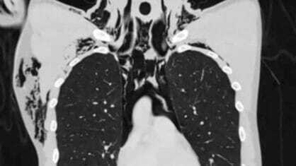Jovem vai para a UTI após desenvolver condição pulmonar rara ao se masturbar