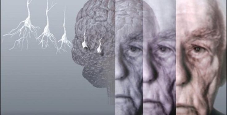 Nova droga dá um alento aos pacientes portadores do mal de Alzheimer