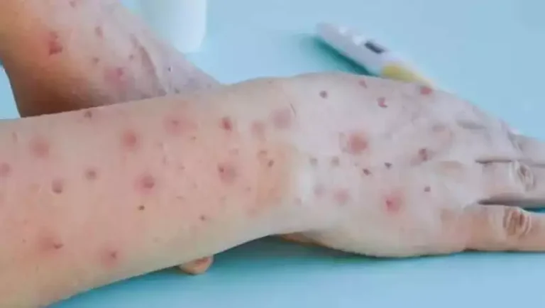 EUA registram primeiros casos de varíola dos macacos em crianças