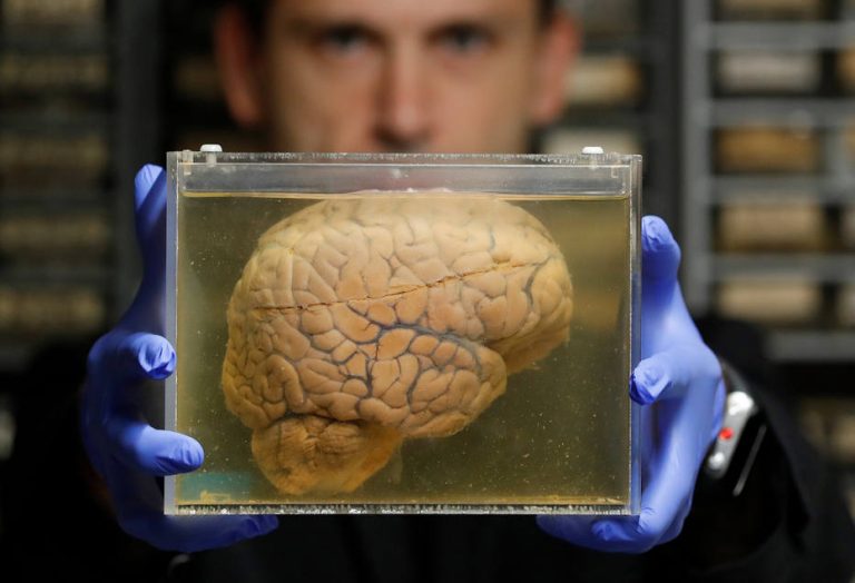 Estudo identifica região do cérebro em que Alzheimer começa a se desenvolver