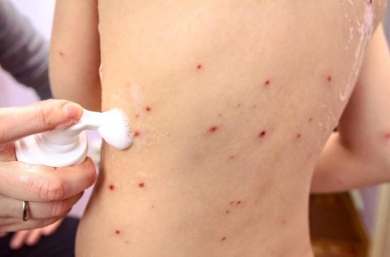 SP tem 2 grávidas e 5 crianças com varíola dos macacos