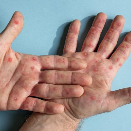 Ilha Solteira registra o seu primeiro caso de varíola dos macacos