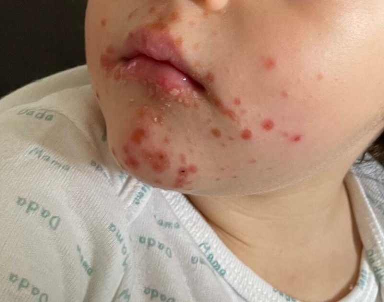 Franca suspende integral ou parcialmente 10 creches por contágio da doença Mão-pé-boca