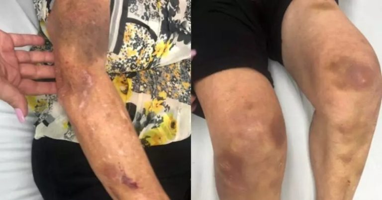Idosa de 62 anos denuncia estupro com desodorante ao dar entrada em UPA com diversos hematomas