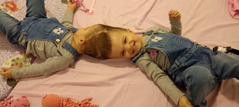 Irmãs siamesas passam por novo procedimento bem-sucedido no HC de Ribeirão Preto