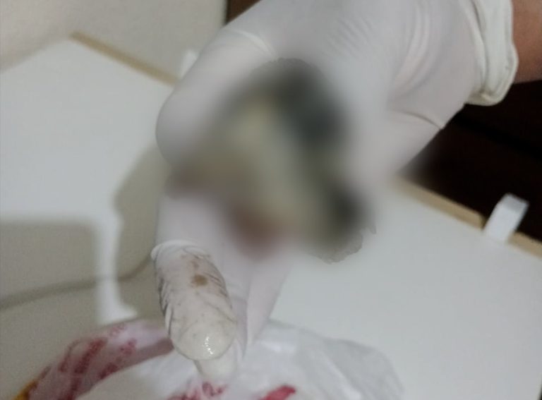 Pais denunciam erro médico durante cirurgia em Limeira, criança vomitou pedaço de gaze