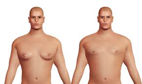 Ginecomastia:  o cirurgião Francisco Tribulato  fala sobre as mamas masculinas