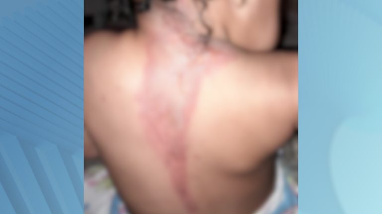 Mãe relata queimaduras em menina de 1 ano e 9 meses em creche de Campinas; prefeitura apura