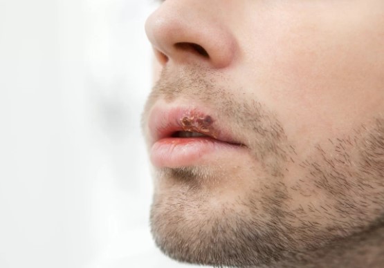 Saiba o que é o câncer de lábio e descubra como prevenir