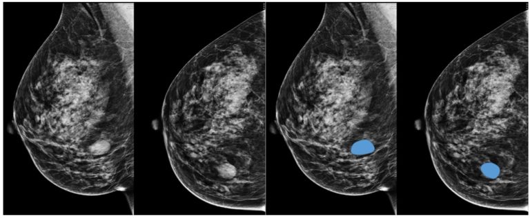 Agendamento de mamografia para mulheres com 50 a 69 anos está disponível no site da prefeitura