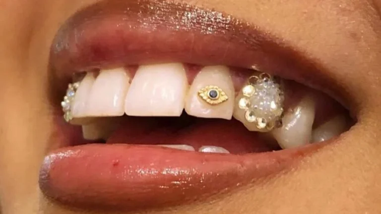Piercings e joias nos dentes são prejudiciais à saúde? Especialista explica
