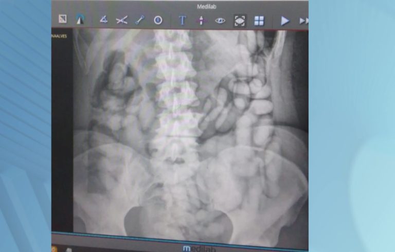 Mulher é presa ao tentar embarcar com drogas no estômago em Viracopos