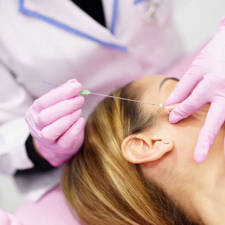 Fios de Sustentação Facial. Será o fim da cirurgia plástica da face?