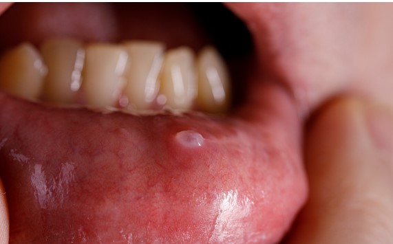 A boca apresenta sinais estranhos? Cuidado! Pode ser câncer