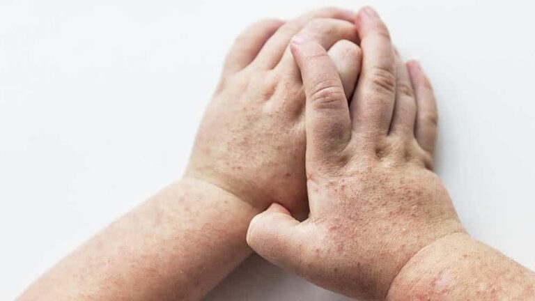 Casos de escarlatina aumentam 600% no último ano em Jacareí