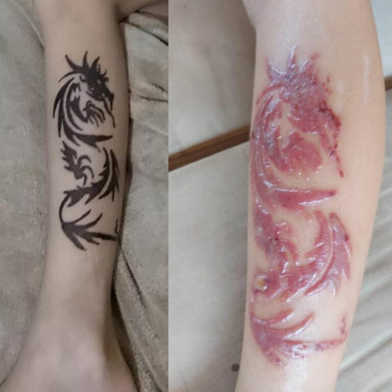 Alerta verão: menino de 8 anos tem reação alérgica após fazer tatuagem de henna