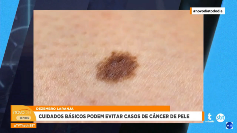 O mês de Dezembro é dedicado à conscientização sobre o câncer de pele, que é o tipo mais comum entre os brasileiros