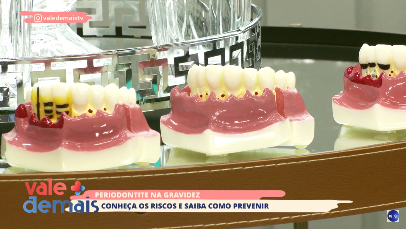 Periodontite na gravidez