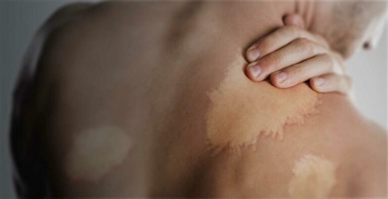 Janeiro roxo: mês para reforçar a prevenção contra a hanseníase