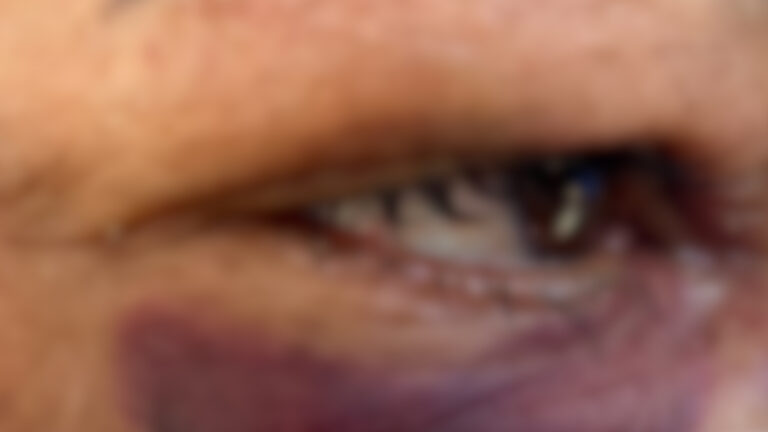 Mulher tem a mandíbula quebrada após ser espancada pelo namorado