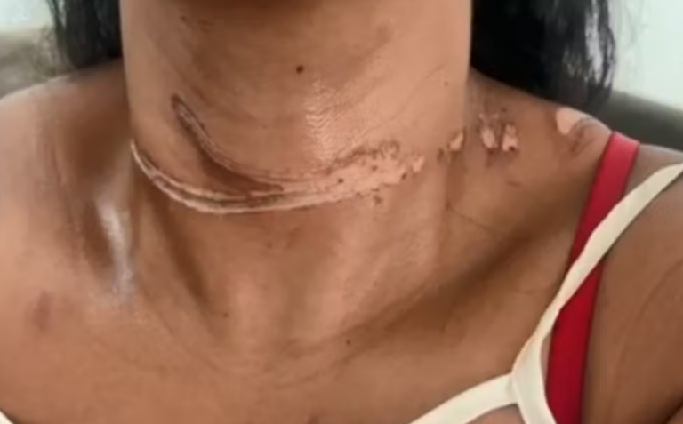 Mulher fica ferida após enroscar pescoço em cabo solto em avenida de Birigui