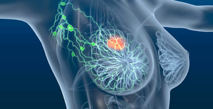 grau-cancer-de-mama O câncer de mama continua sendo o tipo de tumor mais prevalente entre as mulheres do Brasil e do mundo | Foto: Rede social