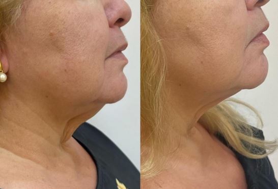 Conheça os procedimentos estéticos faciais que estão com alta procura no mundo da beleza