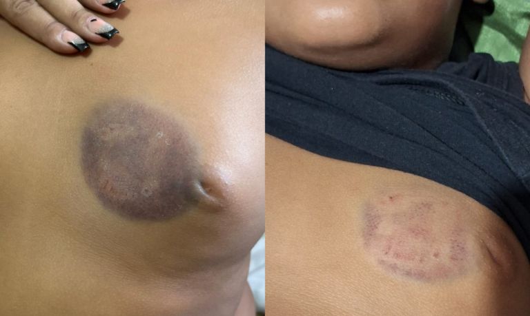 “Marcas do bullying”: Garoto de 7 anos leva mordida no peito de colega de classe e vem sofrendo ataques há 2 meses