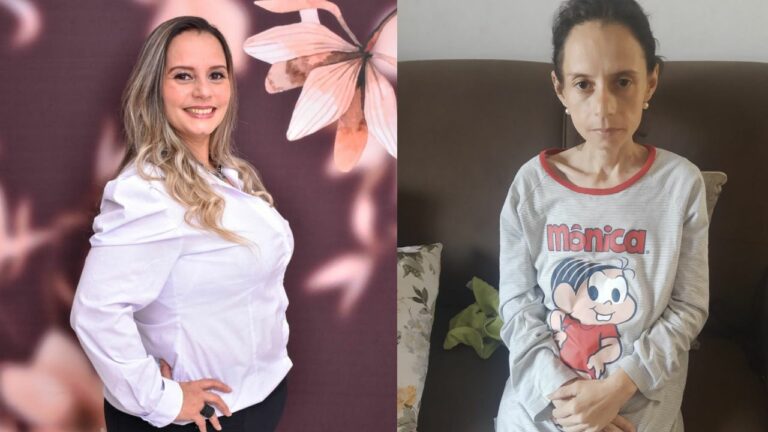 Mulher faz bariátrica e chega a ter anemia devido a magreza extrema: "Cheguei aos 36 kg"