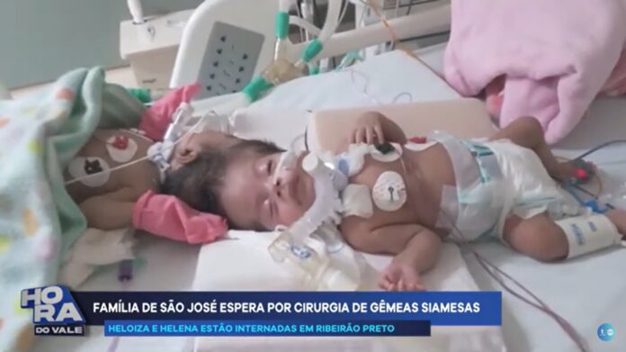 Gêmeas siamesas de São José dos Campos precisam de cirurgia