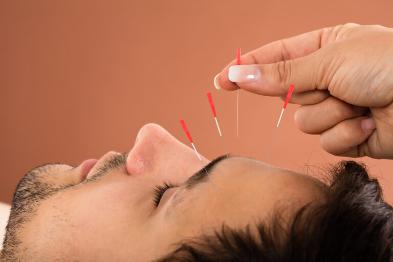 Curso de Fisioterapia precisa de voluntários para pesquisa sobre acupuntura