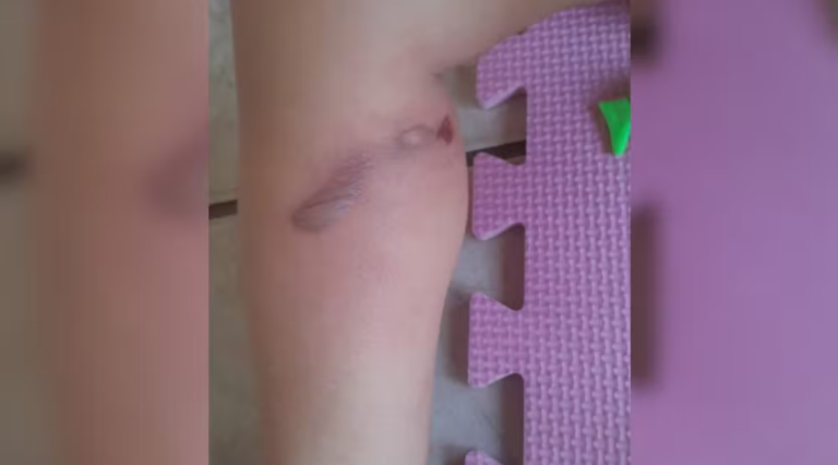 Polícia investiga queimaduras em perna e partes íntimas de bebê creche no interior de SP