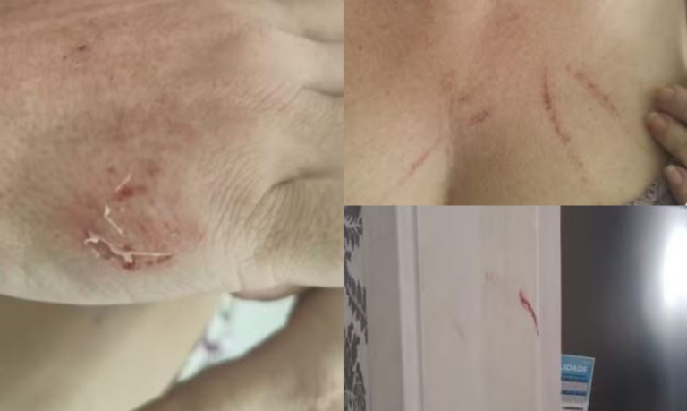 “Puxão de cabelo e mordida na mão”: Briga em condomínio acaba em boletim de ocorrência