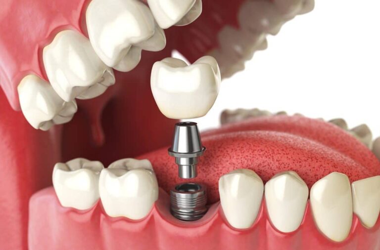 USP precisa de voluntários para colocação de prótese sobre implantes em Ribeirão Preto