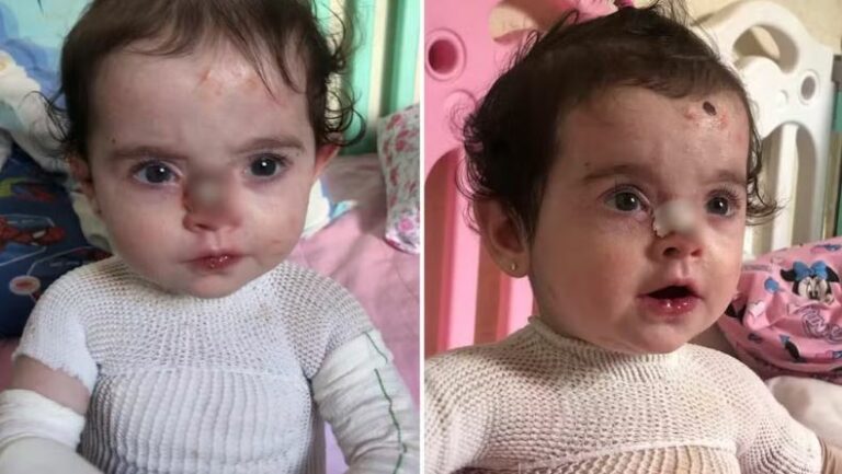 Polícia Civil de Birigui investiga golpe com fotos de criança com doença rara para arrecadar dinheiro na internet