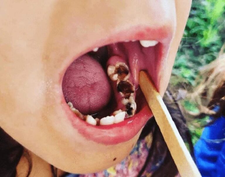 Triagem odontológica para jovens em situação vulnerável acontece nesta quinta-feira em Araçatuba