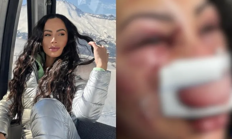 Brasileira agredida durante roubo no Chile diz que lutou com criminosos