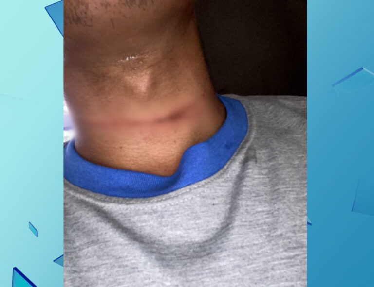 Motoboy tem pescoço cortado por linha de pipa com cerol em Indaiatuba