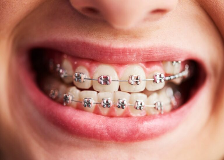 Faculdade de Odontologia precisa de voluntários com aparelho fixo para testar nova pasta de dentes