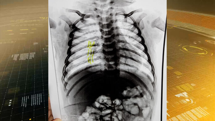 um bebê de apenas dois meses deu entrada na Unidade de Pronto Atendimento (UPA) de Cabreúva em estado crítico, apresentando hematomas por todo o corpo e fraturas nas costelas, indicando graves sinais de violência.