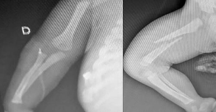 Bebê de seis meses é agredido e internado; Guarda Municipal prende o pai