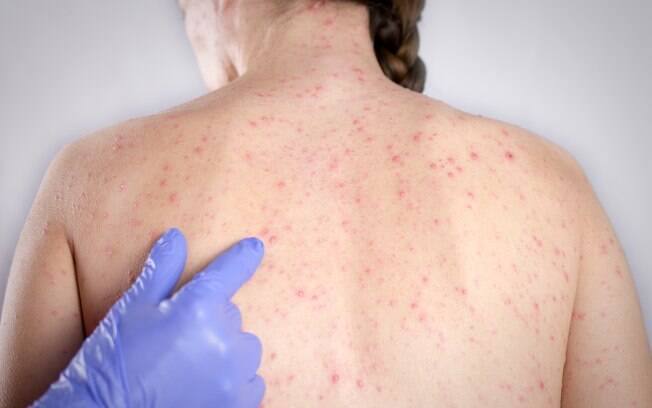 Estado de SP reforça sobre a importância da vacinação contra o sarampo após casos no último mês