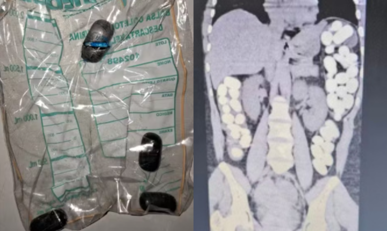 Mulher investigada começa a expelir cápsulas com cocaína identificadas em raio-x, e segue internada em Guarujá
